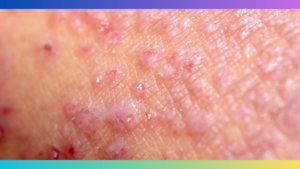 Atopic Seborrheic Dermatitis