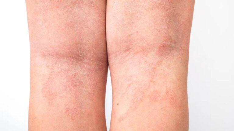Atopic Eczema behind the Knees