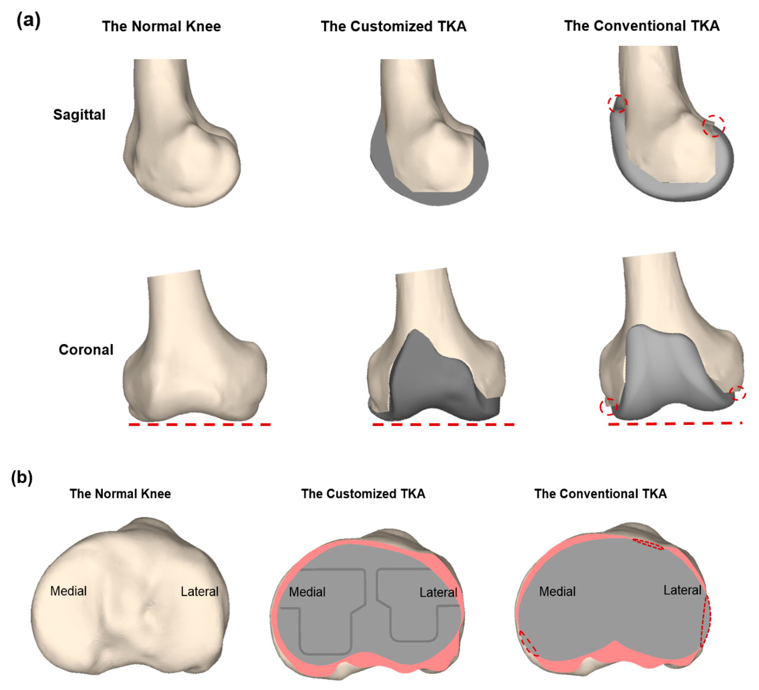 Is A Cartilage Transplant Better Than A Knee Replacement?