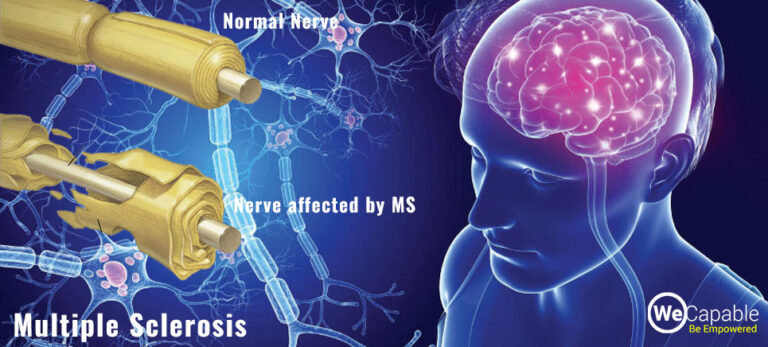 Is It Safe to Get Pregnant With Multiple Sclerosis
