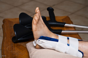 Dealing With Stress Fractures