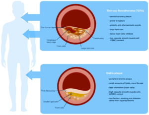 What is the Difference between Coronary Artery Disease And Coronary Artery Calcification